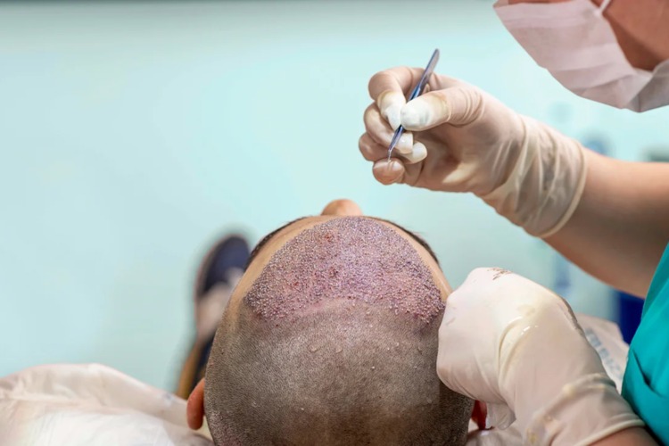 پیوند مو می‌تواند زندگی را برای افراد  با ریزش مو مواجه هستند، تغییر دهد. 